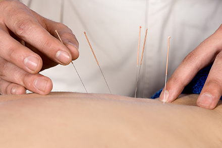 Dry needling Rene Wormhoudt sport fysiotherapie